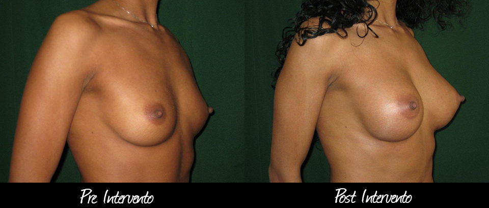 mastoplastica-additiva-risultato