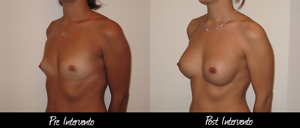 mastoplastica-additiva